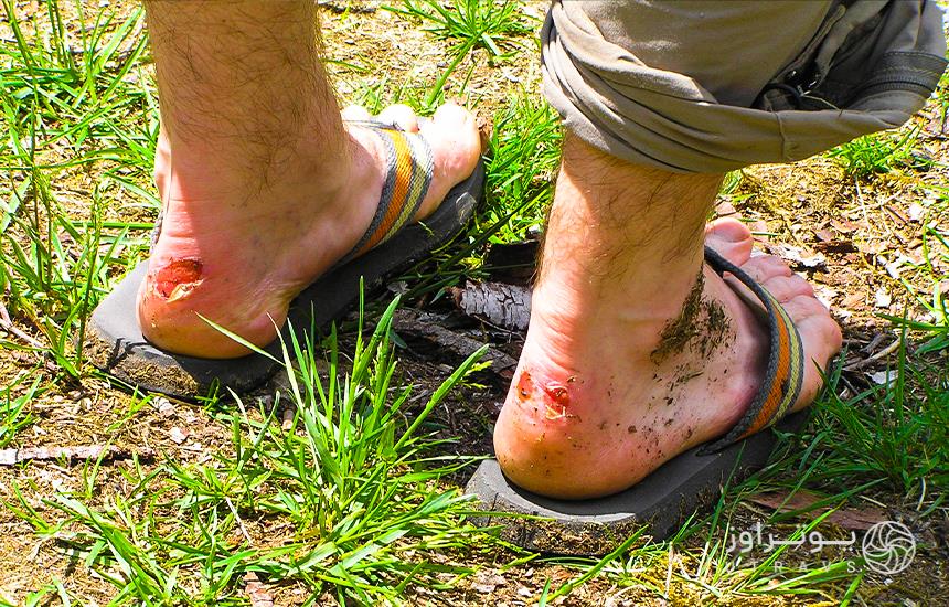 Problems with inappropriate shoes in mountaineering
